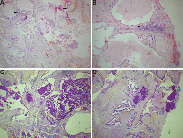 (A) Cystic glandular structures filled with mucin with adjacent epidermoid cells (arrow) and intermediate (double arrow) cells (H and E, ×10). (B) Warthin tumour-like architecture with multiple cystic formations containing lymphocytes (H and E, ×100). (C) Periodic Acid Schiff (PAS) staining showing mucin filled spaces (PAS, ×100). (D) PAS staining showing cystic spaces filled with mucin (PAS, ×100).